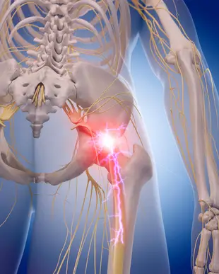How to Get Rid of Sciatic Pain Naturally